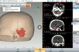 即时3D打印导板辅助脑出血微创手术 黑焰医疗与徐永革团队助力基层医院