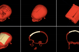 研究人员发布免费的自动化设计软件以生产3D打印颅骨植入物