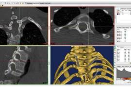 土耳其大学研究人员评估3D打印在脊柱外科中的应用