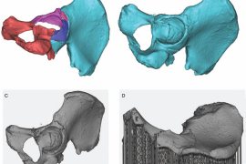中美研究人员确定3D打印可更有效地治疗髋部骨折