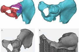 中美研究人員確定3D打印可更有效地治療髖部骨折