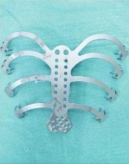男子患胸骨肿瘤 医生给他3D打印了一套“铁骨”