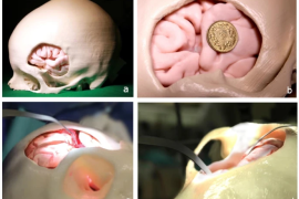 探索3D打印辅助模拟颅内动脉瘤显微手术的应用